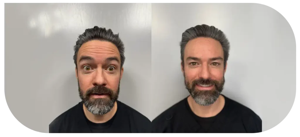 Before and after Botox and dermal fillers results on forehead wrinkles