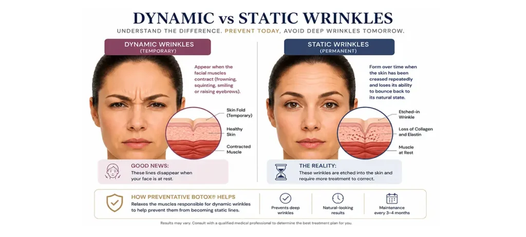 Dynamic vs static wrinkles diagram — how preventative Botox Franklin Park IL stops wrinkles before they form