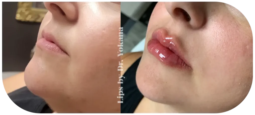 before and after med spa treatment Franklin Park IL